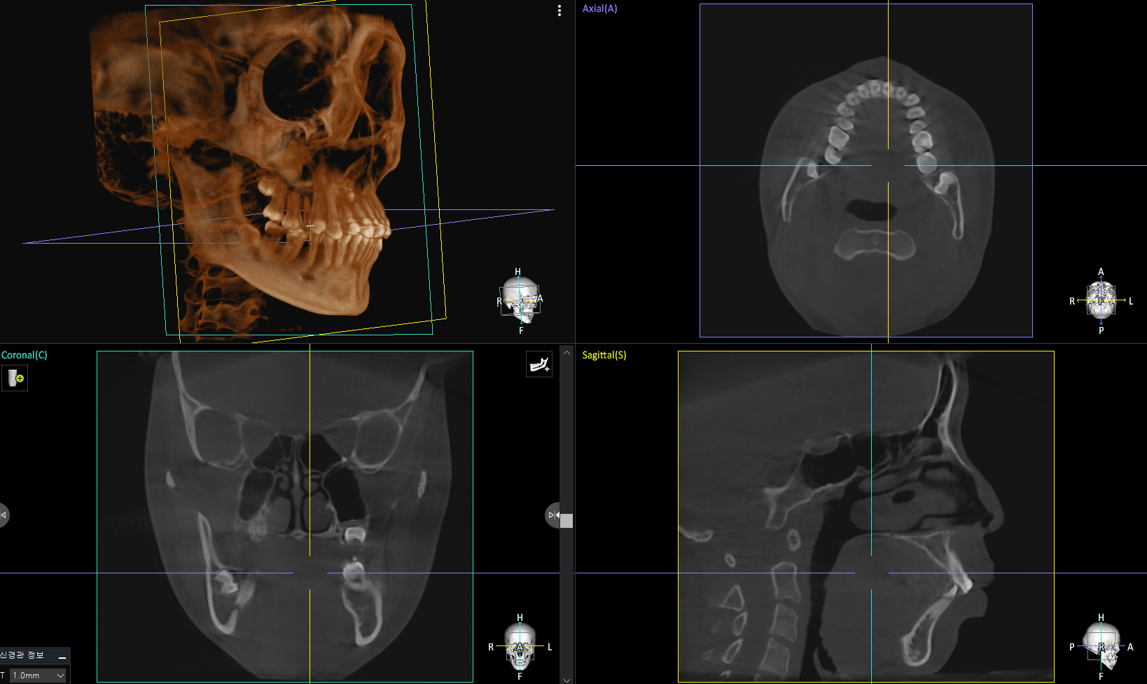 3D CT